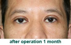 plastic-surgery-blepharoplasty